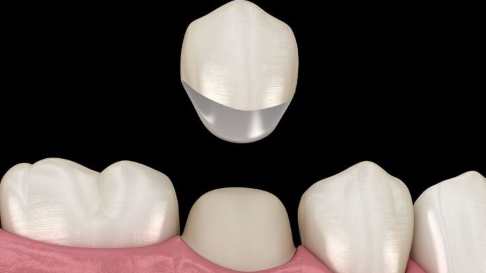 Ceramic Crowns